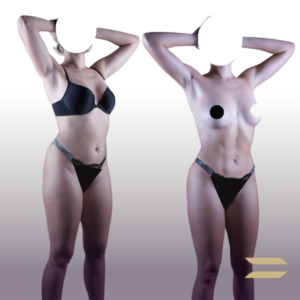 Liposuction