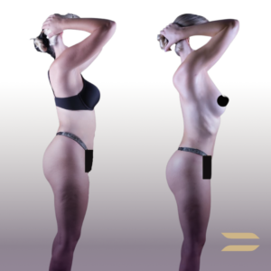 Liposuction