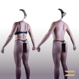 Liposuction