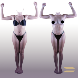 Liposuction
